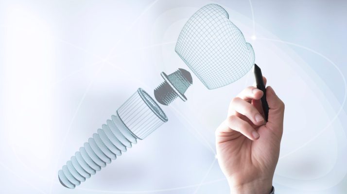 portada-implantes-dentales-paso-a-paso-y-cuidados-clave-clinica-dental-san-agustin-fuente-alamo-www.clinicadentalsanagustin.es